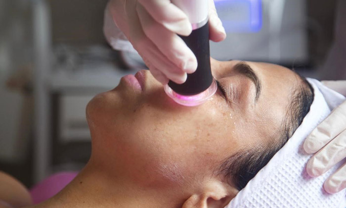 5 טיפול פנים RF ליפטינג בקליניקת L.O beauty, הרצליה