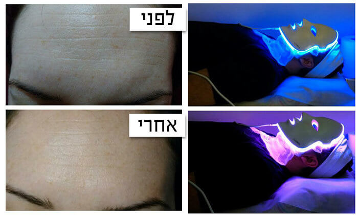 4 טיפולי פנים בגלי רדיו בקליניקת עדי קוסמטיקס,תל אביב