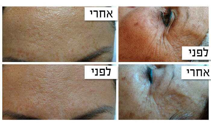 3 טיפולי פנים בגלי רדיו בקליניקת עדי קוסמטיקס,תל אביב